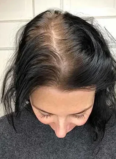 Lastuce-naturelle-et-magique-pour-stopper-la-chute-de-cheveux_-1200x628